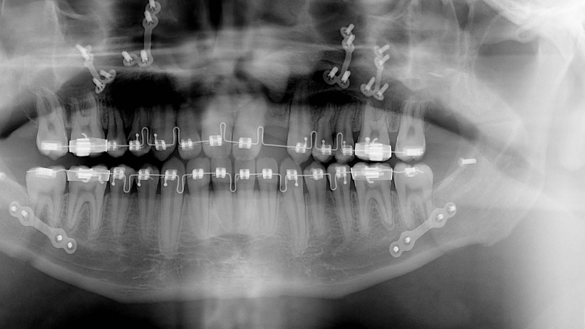 Neden Ortodontik Tedavi Görülmelidir?