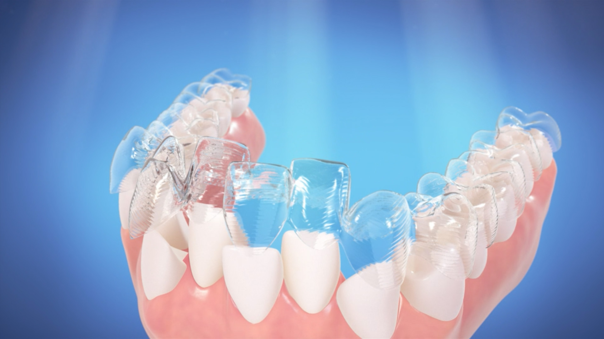 Şeffaf Plak Tedavisi (Telsiz Ortodonti) Hangi Hastalıklarda Uygulanır?